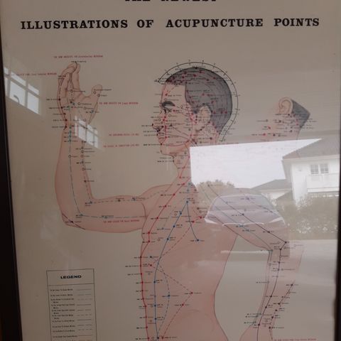 Akupunktur plakat, i ramme. Flott på klinikken.