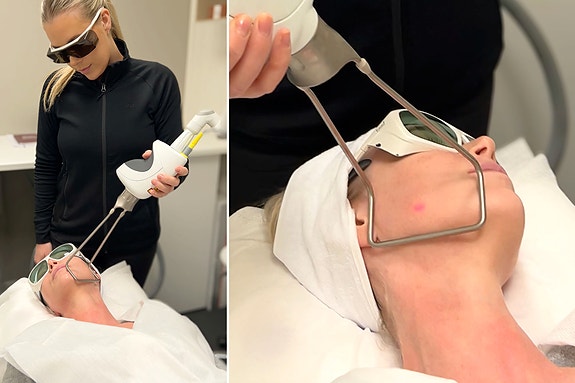 Fotona tightening 4D